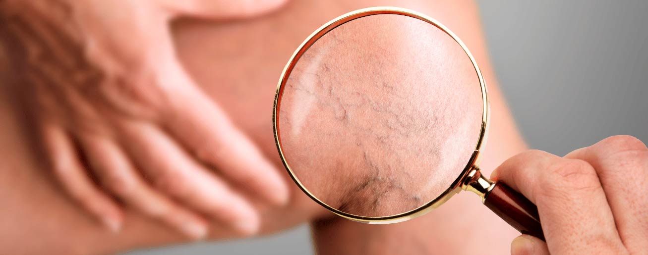 spx-clinica-spx-imagem-varizes-dores-e-inchaço-nas-pernas