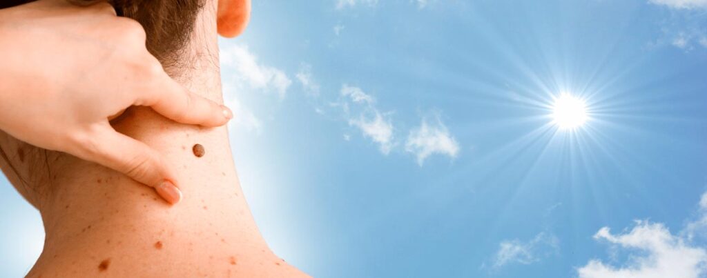 spx-clinica-spx-imagem-80-dos-melanomas-sao-causados-por-raios-uv