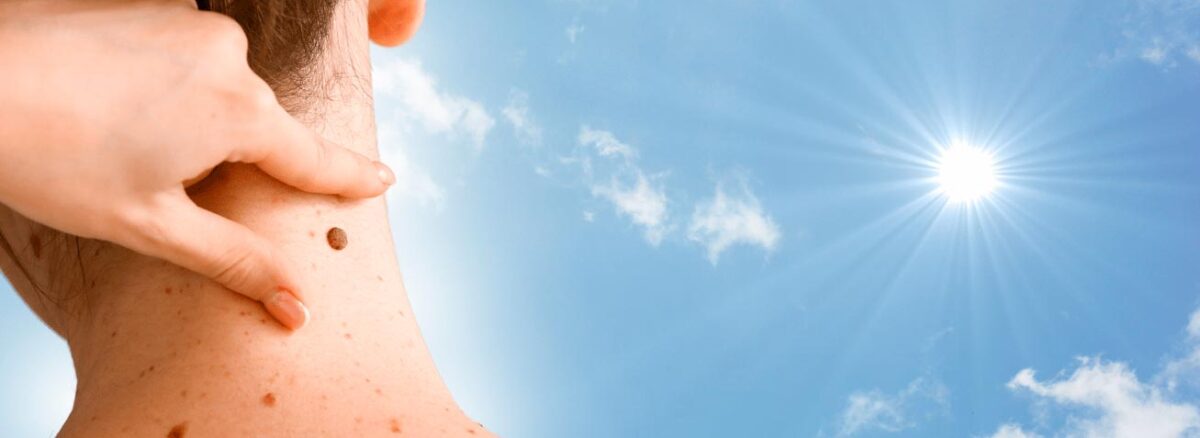 spx-clinica-spx-imagem-80-dos-melanomas-sao-causados-por-raios-uv