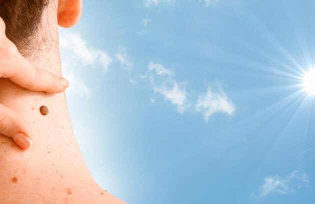spx-clinica-spx-imagem-80-dos-melanomas-sao-causados-por-raios-uv