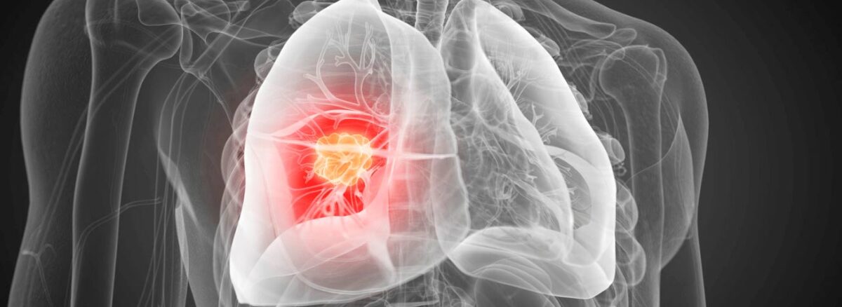 spx-clinica-spx-imagem-deteccao-de-cancer-de-pulmao