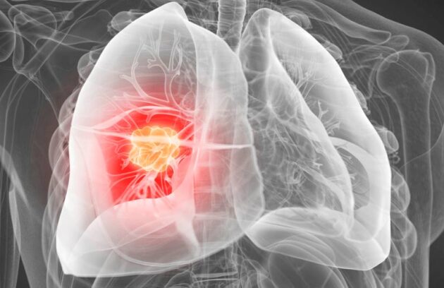 spx-clinica-spx-imagem-deteccao-de-cancer-de-pulmao