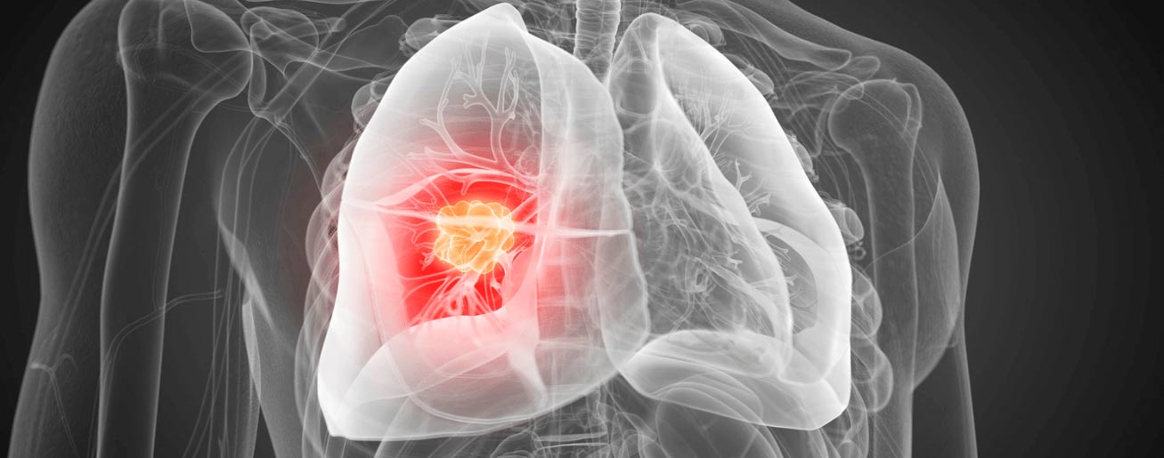 spx-clinica-spx-imagem-deteccao-de-cancer-de-pulmao