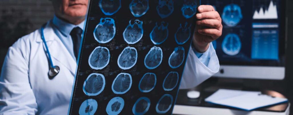 spx-clinica-spx-imagem-litio-pode-combater-o-alzheimer