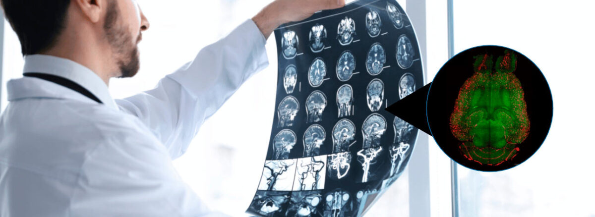 spx-clinica-spx-imagem-nanoparticulas-ajudam-a-reverter-alzheimer