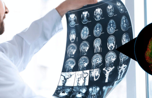 spx-clinica-spx-imagem-nanoparticulas-ajudam-a-reverter-alzheimer