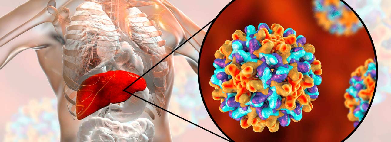 Representação de um fígado com hepatite tipo B