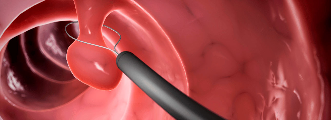 Imagem de um pólipo