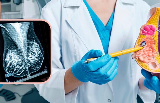 Calcificações no resultado do exame de Mamografia