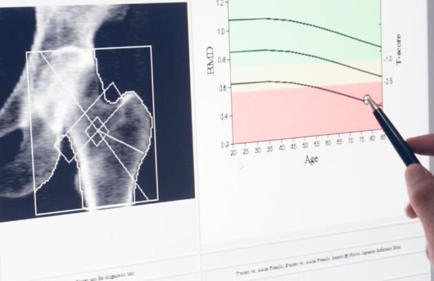 Indicadores t-score e z-score na densitometria óssea