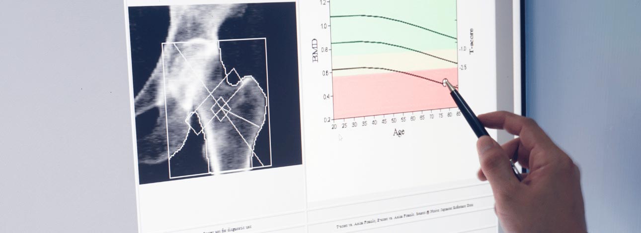 Indicadores t-score e z-score na densitometria óssea