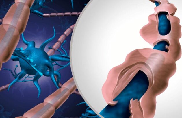 Representação de esclerose múltipla