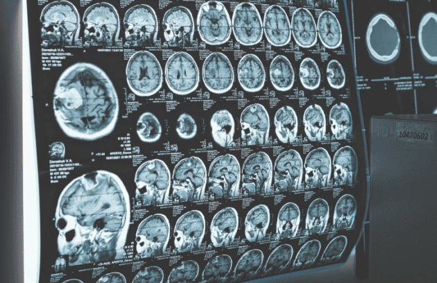 Resultado de exame cerebral