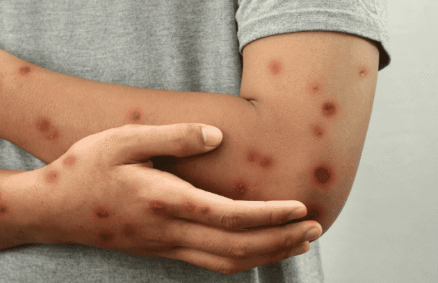 Pessoa com os braços cruzados com o vírus mpox