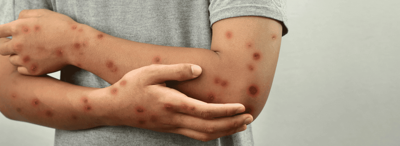 Pessoa com os braços cruzados com o vírus mpox