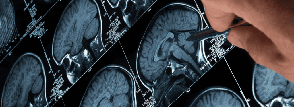 Laudo médico com imagem cerebral