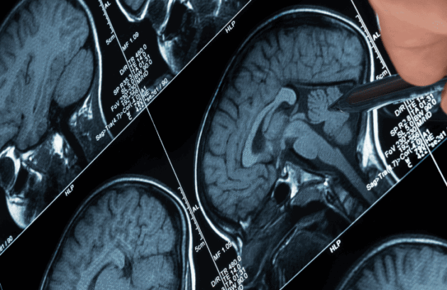 Laudo médico com imagem cerebral