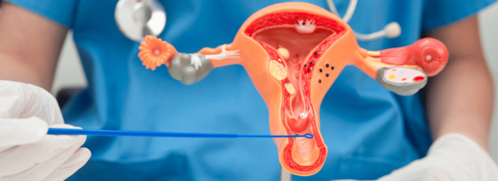 Médico segurando modelo de útero humano para exame de Papanicolau vaginal e cervical