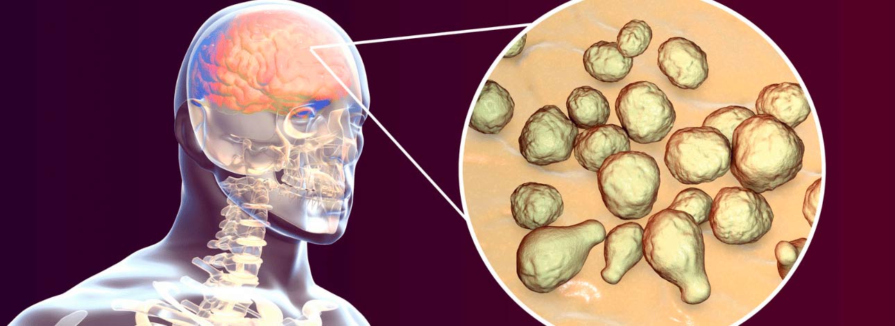 Representação da meningite bacteriana