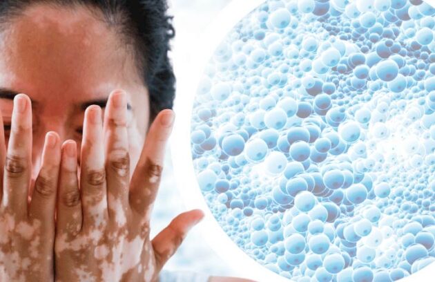 Mulher com vitiligo com fundo de célula